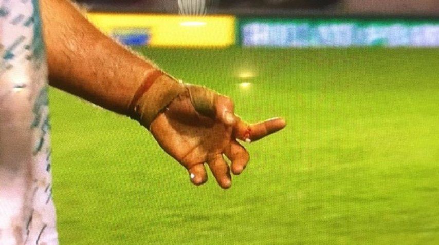 Quiso seguir jugando con fractura expuesta