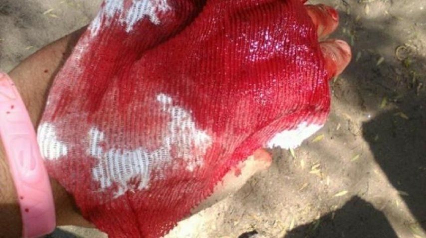 Así le quedó la mano tras la mordida de la tararira<br>