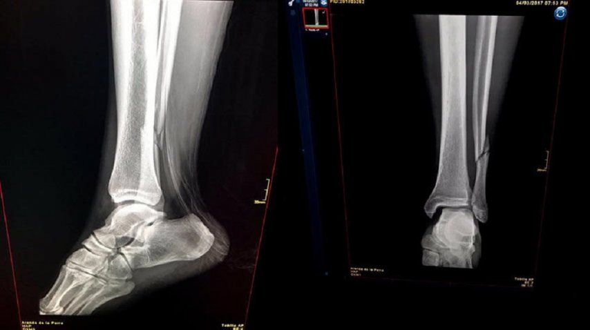 Radiografía de la lesión de Renato Ibarra