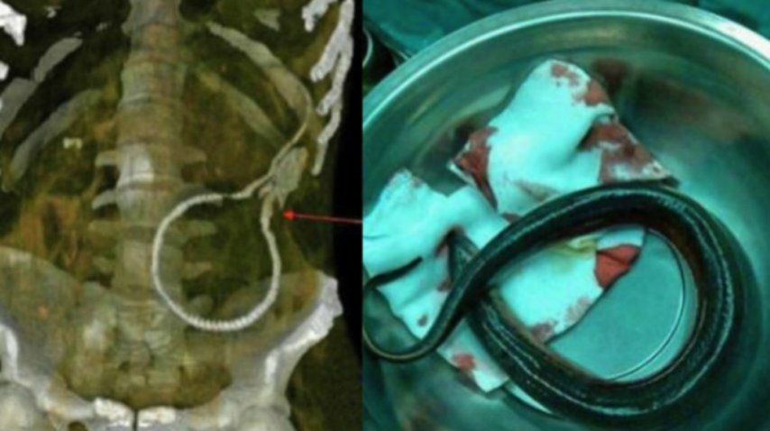 Así estaba la anguila en el cuerpo del hombre