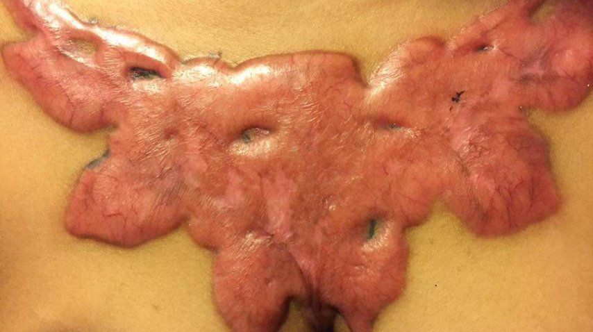 <p> Una joven se quitó un tatuaje de su cuerpo y el resultado es un desastre</p><p></p>