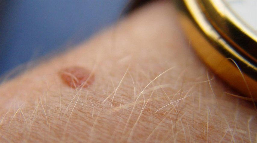 <p> Día Mundial del Melanoma</p><p></p>