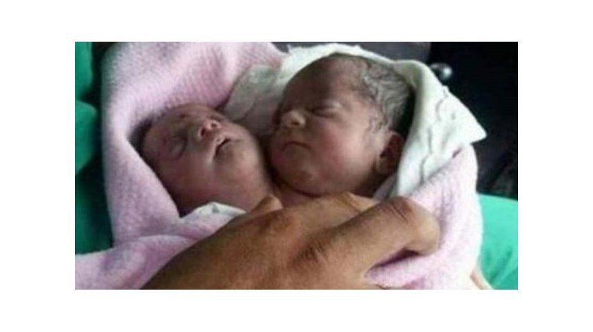 Nació un bebé con dos cabezas en Siria